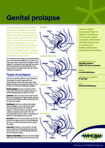 Genital prolapse Genital prolapse occurs when pelvic organs (uterus, bladder, rectum) slip down from their normal anatomical position and either protrude into the vagina or press against the wall of the