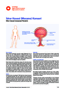 İdrar Kesesi (Mesane) Kanseri İdrar kesesi (mesane) Tümörü böbrekleri idrar kese­ sine bağlayan bir çift idrar kanalının (üreter)