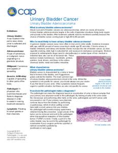 Urinary Bladder Cancer Urinary Bladder Adenocarcinoma What is urinary bladder adenocarcinoma? Definitions Urinary bladder: A sac located in the