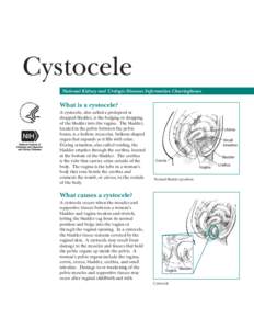 Cystocele National Kidney and Urologic Diseases Information Clearinghouse What is a cystocele? A cystocele, also called a prolapsed or dropped bladder, is the bulging or dropping