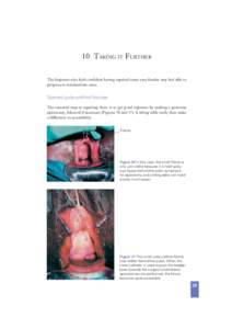 10 TAKING IT FURTHER The beginner who feels conﬁdent having repaired some easy ﬁstulae may feel able to progress to intermediate cases. Scarred juxta-urethral ﬁstulae The essential step in repairing these is to get