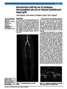 Images in…  Reconstruction with the use of autologous femoropopliteal veins for an infected aortobifemoral bypass graft Jakub Kaczynski,1 Steve Atherton,2 Christopher G Davies,2 Colin J Ferguson3