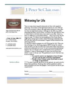 Whitening for Life Upper Teeth bleached with our power bleaching system.