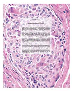 Giant-cell tumor of bone / Sarcoma / Rare diseases / Histiocytoma / CD34 / Histiocyte / Soft-tissue sarcoma / Solitary fibrous tumor / Pigmented villonodular synovitis / Medicine / Oncology / Gynaecological cancer