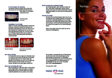 In vorm brengen van de facing Uw tandarts maakt een afdruk van uw tand. Die afdruk gaat naar het tandtechnisch laboratorium. Daar maken ze uw facing in de gewenste vorm.