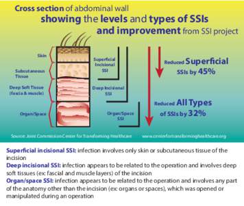 SSI Abdominal Wall Infographic