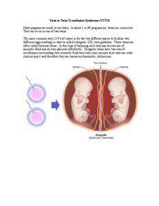 Twin to Twin Transfusion Syndrome (TTTS) Most pregnancies result in one baby. In about 1 in 80 pregnancies, twins are conceived. This can occur in one of two ways.