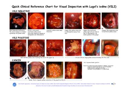 Quick Clinical Reference Chart for Visual Inspection with Lugol’s iodine (VILI) VILI NEGATIVE Black squamous epithelium. No colour change in columnar epithelium. No yellow areas