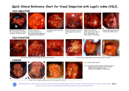 Histopathology / Gynaecological cancer / Papillomavirus / Epithelial cells / Squamous metaplasia / Cervical cancer / Polyp / Metaplasia / Epithelium / Medicine / Biology / Anatomy