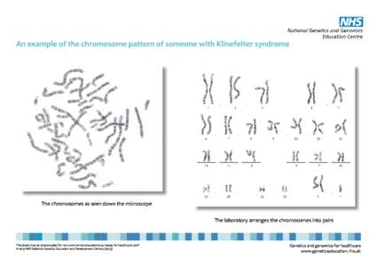 47xxy - Klinefelter syndrome.indd