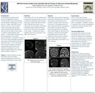 MRI-thermometry Guided Laser Interstitial Thermal Therapy for Recurrent Cerebral Metastases Analiz Rodriguez MD, PhD; Stephen B. Tatter MD, PhD Department of Neurosurgery, Wake Forest University Baptist Medical Center In