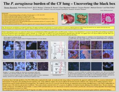 The P. aeruginosa burden of the CF lung – Uncovering the black box Thomas Bjarnsholt1, Peter Østrup Jensen2, Kit G. Madsen3, Christine R. Hansen2, Claus Bøgelund Andersen2, Tacjana Pressler2, Michael Givskov1 and Nie