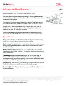 .org Calcaneus (Heel Bone) Fractures Page[removed]Fractures of the heel bone, or calcaneus, can be disabling injuries.