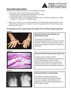Arthritis / Rheumatoid arthritis / Rheumatology / Ulnar deviation / Metacarpophalangeal joint / Ankylosis / Bunion / Anatomy / Health / Medicine