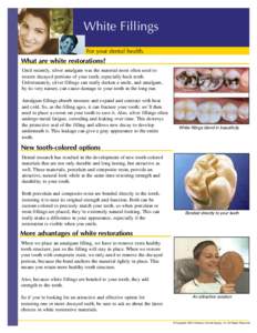 White Fillings For your dental health. What are white restorations? Until recently, silver amalgam was the material most often used to restore decayed portions of your teeth, especially back teeth.