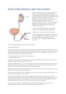 Esnek Üreteroskopi ile Lazer Taş Cerrahisi Esnek üreteroskop ince fiber optik bir teleskopun üretra (idrar kanalı) yoluyla mesaneden böbreğe uzatılması yöntemidir (şekle bakınız). Bu aletin çapı 2mm’den 
