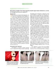 My patients complain about food impaction around single implant restorations. Can this be managed and how can I prevent it? Background here are many reasons for food impaction, but it may occur more often around implants