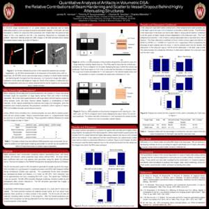 Quantitative Analysis of Artifacts in Volumetric DSA: the Relative Contributions of Beam Hardening and Scatter to Vessel Dropout Behind Highly Attenuating Structures James R. Hermusa,b , Timothy P. Szczykutowicza,c , Cha