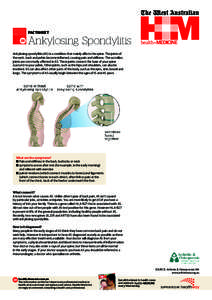 FACTSHEET  Ankylosing Spondylitis Ankylosing spondylitis (AS) is a condition that mainly affects the spine. The joints of the neck, back and pelvis become inflamed, causing pain and stiffness. The sacroiliac joints are c