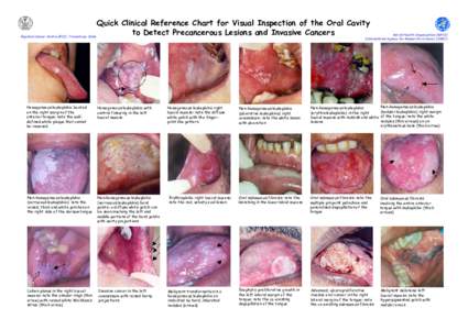 Quick Clinical Reference Chart for Visual Inspection of the Oral Cavity to Detect Precancerous Lesions and Invasive Cancers Regional Cancer Centre (RCC), Trivandrum, India World Health Organization (WHO) International Ag