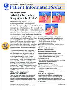 AMERICAN THORACIC SOCIETY  Patient Information Series SLEEP MINI-SERIES #2  NORMAL AIRWAY