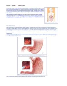 Gastric Cancer:  Introduction The geographic incidence of gastric cancer has changed dramatically over the last few decades. Prior to 1950, it was the most common cause of cancer death in men, and the third leading cause