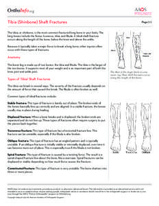 .org Tibia (Shinbone) Shaft Fractures Page[removed]The tibia, or shinbone, is the most common fractured long bone in your body. The