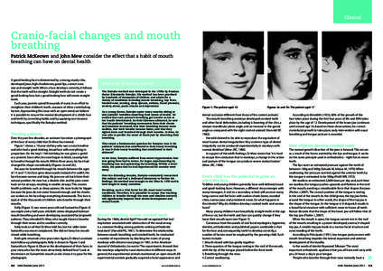 Clinical  Cranio-facial changes and mouth breathing Patrick McKeown and John Mew consider the effect that a habit of mouth breathing can have on dental health
