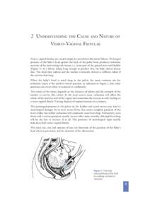 2 UNDERSTANDING THE CAUSE AND NATURE OF VESICO-VAGINAL FISTULAE Vesico-vaginal ﬁstulae are caused simply by unrelieved obstructed labour. Prolonged pressure of the baby’s head against the back of the pubic bone produ