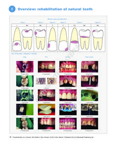 1  Overview: rehabilitation of natural teeth Black’s cavity classification Class I B/L
