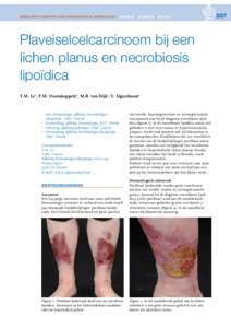 NEDERLANDS TIJDSCHRIFT VOOR DERMATOLOGIE EN VENEREOLOGIE | VOLUME 24 | NUMMER 05 | meiPlaveiselcelcarcinoom bij een lichen planus en necrobiosis ­lipoïdica T.M. Le1, P.M. Ossenkoppele2, M.R. van Dijk3, V. Sigurd