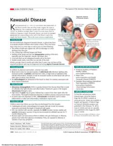 Diagnostic features of Kawasaki disease Kawasaki Disease  Fever (for more