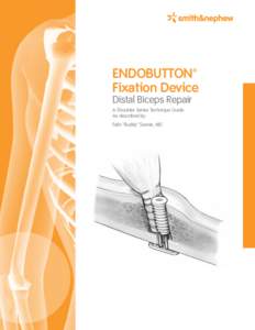 ENDOBUTTON™ Fixation Device Distal Biceps Repair A Shoulder Series Technique Guide As described by: Felix “Buddy” Savoie, MD