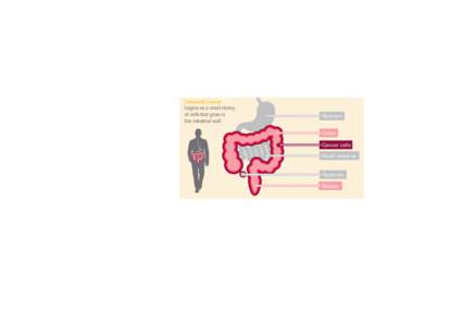 Contents  Overview Section 1 Colorectal cancer