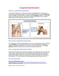 Dislocation of hip / Orthopedic surgery / Joint dislocation / Hip / Dislocation / Femur / Hip dysplasia / Arthroplasty / Medicine / Anatomy / Health