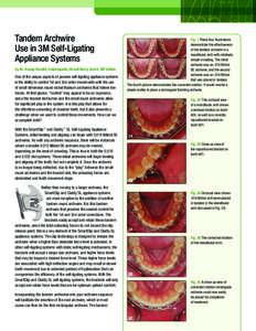 Clarity™ SL and SmartClip™ SL3 Self-Ligating Brackets