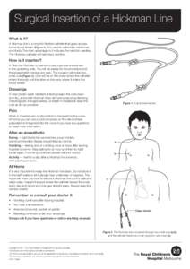 Surgical Insertion of a Hickman Line What is it? A Hickman line is a long thin flexible catheter that gives access to the blood stream (Figure 1). It is used to administer medicines and fluids. The main advantage is it 