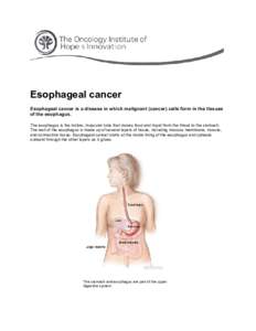 Esophageal cancer Esophageal cancer is a disease in which malignant (cancer) cells form in the tissues of the esophagus. The esophagus is the hollow, muscular tube that moves food and liquid from the throat to the stomac