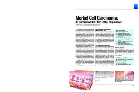 Carcinoma / Merkel cell carcinoma / Gynaecological cancer / Histopathology / Merkel cell polyomavirus / Skin cancer / Cancer / Squamous-cell carcinoma / Breast cancer / Medicine / Oncology / Melanoma