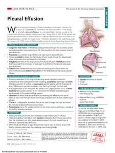 The Journal of the American Medical Association  Pleural Effusion Individual with pleural effusion