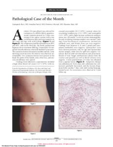 Pityriasis lichenoides et varioliformis acuta / Pityriasis lichenoides / Rare diseases / Pityriasis / Cutaneous T-cell lymphoma / Degos disease / Chickenpox / Health / Medicine / Dermatology