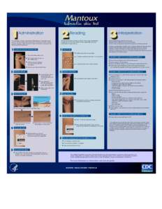 Poster | Mantoux tuberculin skin test