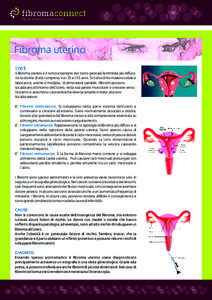 fibromaconnect Hub per le pazienti con ﬁbromi uterini Fibroma uterino COS’È Il ﬁbroma uterino è il tumore benigno del tratto genitale femminile più diﬀuso