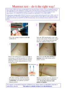 Mantoux test / Tuberculin / Syringe / Heaf test / Latent tuberculosis / Tuberculosis / Medicine / Immunologic tests