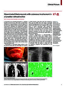 Clinical Picture  Disseminated blastomycosis with cutaneous involvement in a Canadian railroad worker Reed A C Siemieniuk, Derek R MacFadden, Larissa M Matukas