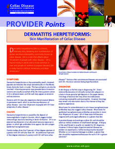 Provider Points Dermatitis Herpetiformis: Skin Manifestation of Celiac Disease  D