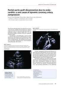 I MA G E S I N C A R D I O VA S C U L A R ME D ICIN E  Partial aortic graft disconnection due to endo­ carditis: a rare cause of dynamic coronary artery compression Annina A. Studer Bruengger a, David J. Kurza, Michele 