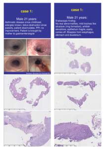 Colitis / Autoimmune diseases / Abdominal pain / Microscopic colitis / Collagenous colitis / Eosinophilic esophagitis / Lymphocytic colitis / Eosinophilic gastroenteritis / Gastroesophageal reflux disease / Health / Gastroenterology / Medicine