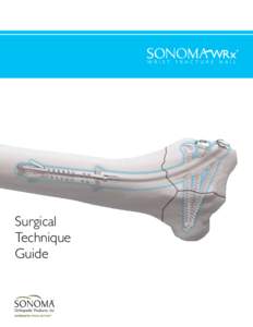 Bone fractures / Long bones / Orthopedic surgery / Implants / Traumatology / Distal radius fracture / Kirschner wire / Radial styloid process / Radius / Anatomy / Medicine / Human anatomy