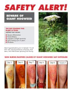 Medicine / Heracleum / Biology / Ecology / Blister / Sunlight / Photodermatitis / Phytophotodermatitis / Apiaceae / Invasive plant species / Heracleum mantegazzianum